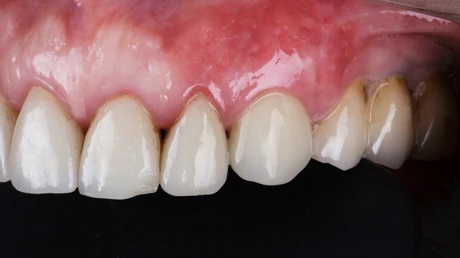 L'Abcès parodontal