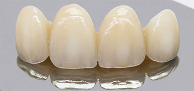 Pont fixe conventionnel sur dents naturelles